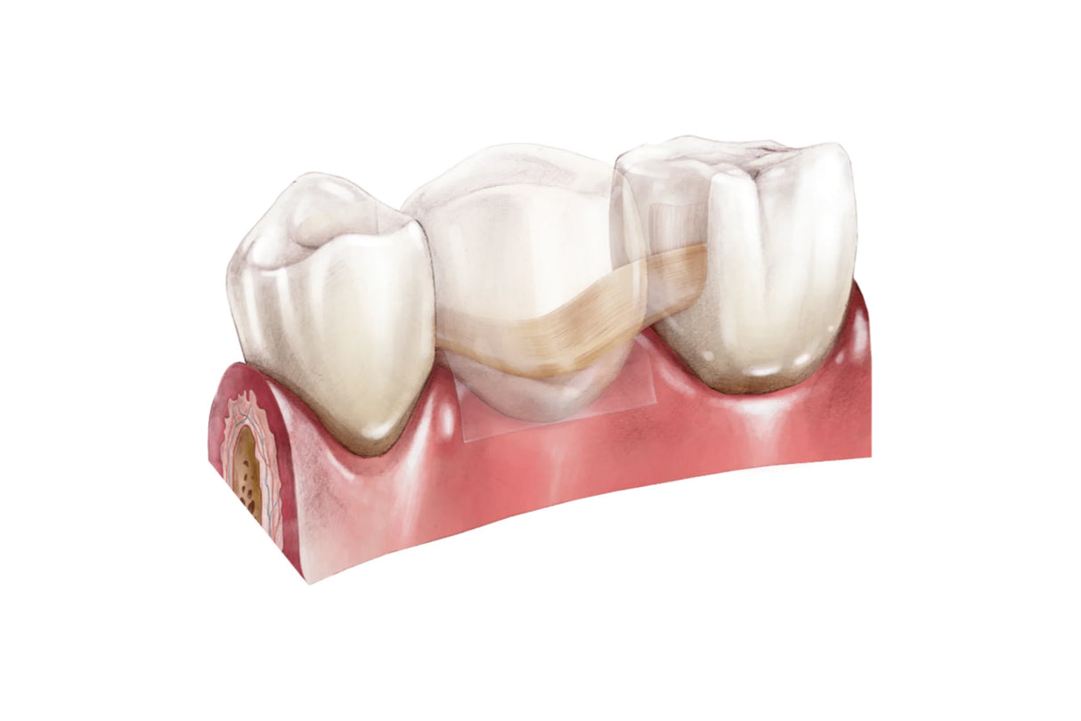 Comcord kompositbånd med fiberforstærkning, pakning med 6 cm